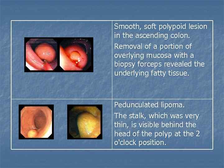 Smooth, soft polypoid lesion in the ascending colon. Removal of a portion of overlying