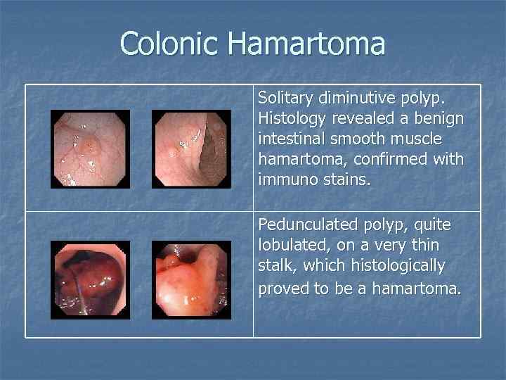 Colonic Hamartoma Solitary diminutive polyp. Histology revealed a benign intestinal smooth muscle hamartoma, confirmed