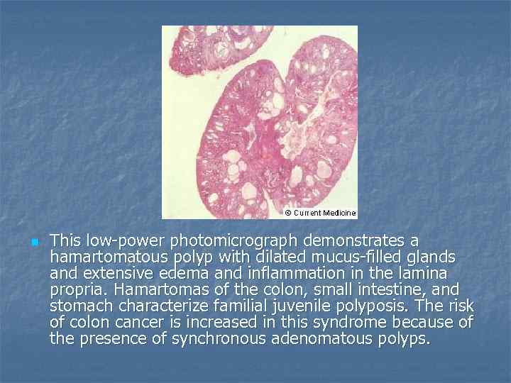 n This low-power photomicrograph demonstrates a hamartomatous polyp with dilated mucus-filled glands and extensive