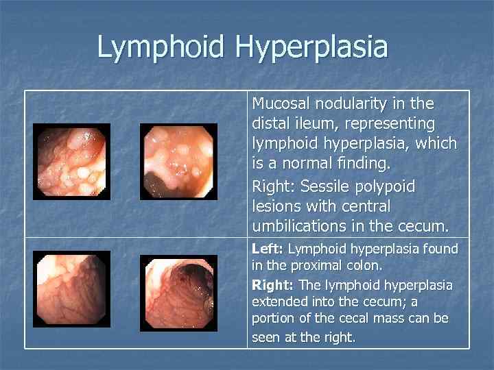 Lymphoid Hyperplasia Mucosal nodularity in the distal ileum, representing lymphoid hyperplasia, which is a