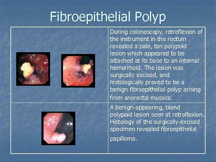 fibroepithelial papillomas