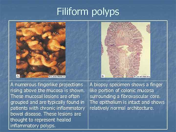 Filiform polyps A numerous fingerlike projections rising above the mucosa is shown. These mucosal