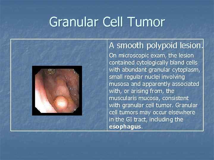 Granular Cell Tumor A smooth polypoid lesion. On microscopic exam, the lesion contained cytologically