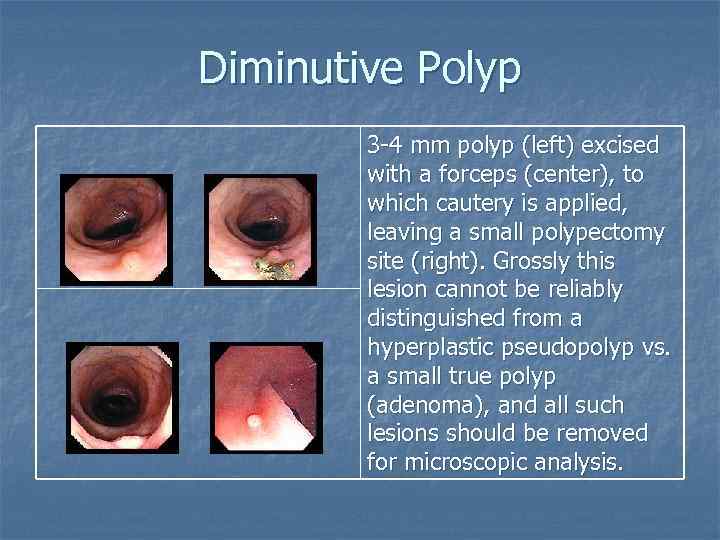 Diminutive Polyp 3 -4 mm polyp (left) excised with a forceps (center), to which