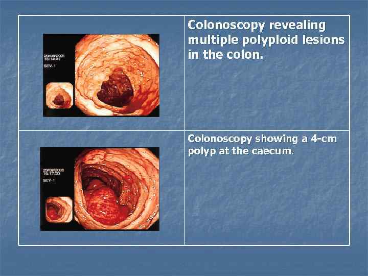 Colonoscopy revealing multiple polyploid lesions in the colon. Colonoscopy showing a 4 -cm polyp