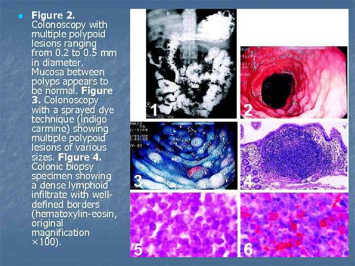 n Figure 2. Colonoscopy with multiple polypoid lesions ranging from 0. 2 to 0.