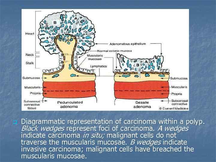 q Diagrammatic representation of carcinoma within a polyp. Black wedges represent foci of carcinoma.