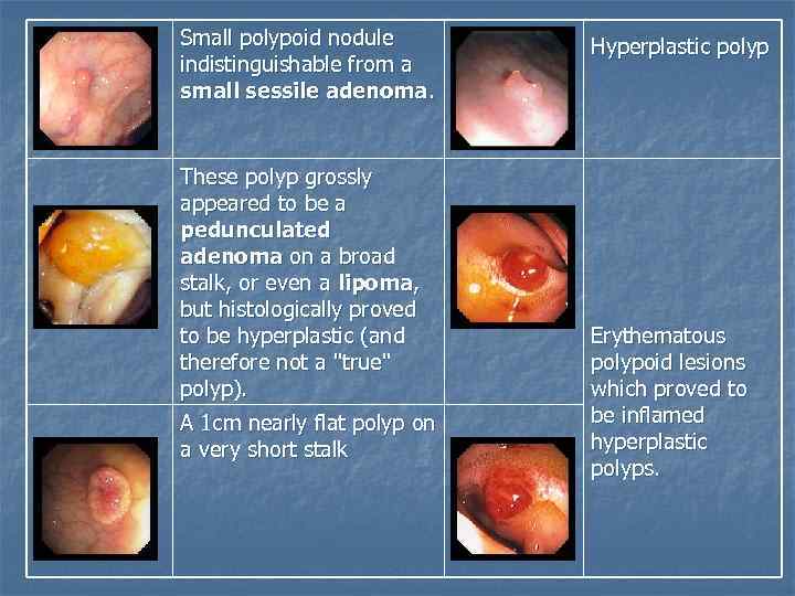 Small polypoid nodule indistinguishable from a small sessile adenoma. These polyp grossly appeared to