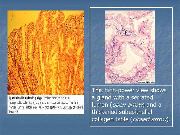 This high-power view shows a gland with a serrated lumen (open arrow) and a