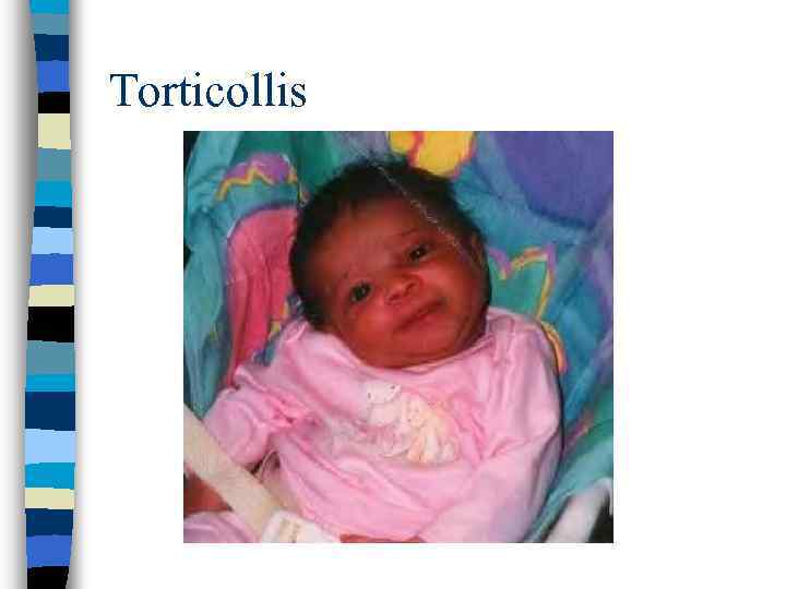 Torticollis 