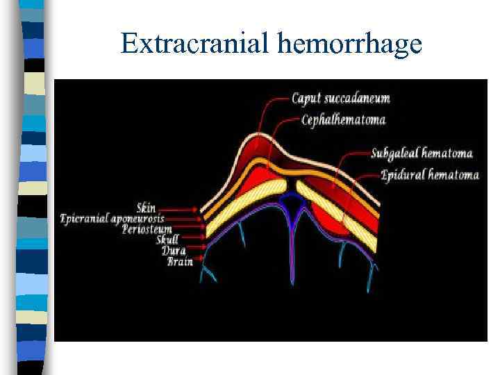 Extracranial hemorrhage 