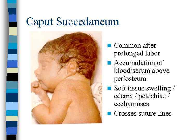 Caput Succedaneum Common after prolonged labor n Accumulation of blood/serum above periosteum n Soft