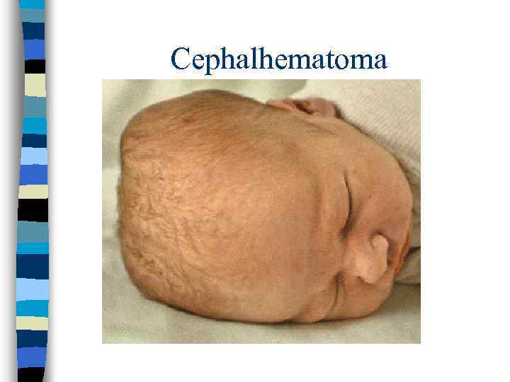 Cephalhematoma 