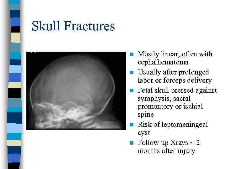 Skull Fractures n n n Mostly linear, often with cephalhematoma Usually after prolonged labor