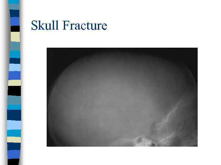 Skull Fracture 