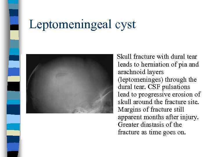 Leptomeningeal cyst Skull fracture with dural tear leads to herniation of pia and arachnoid