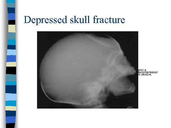 Depressed skull fracture 