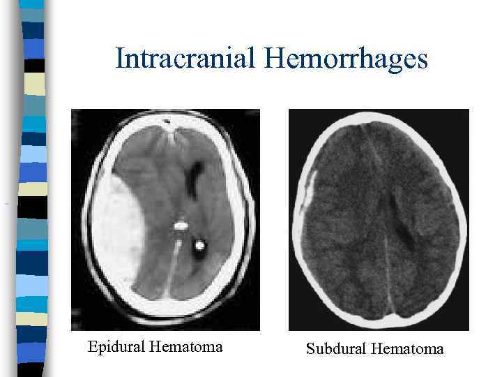 Intracranial Hemorrhages Epidural Hematoma Subdural Hematoma 