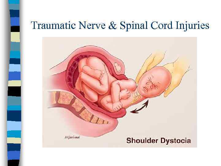 Traumatic Nerve & Spinal Cord Injuries 