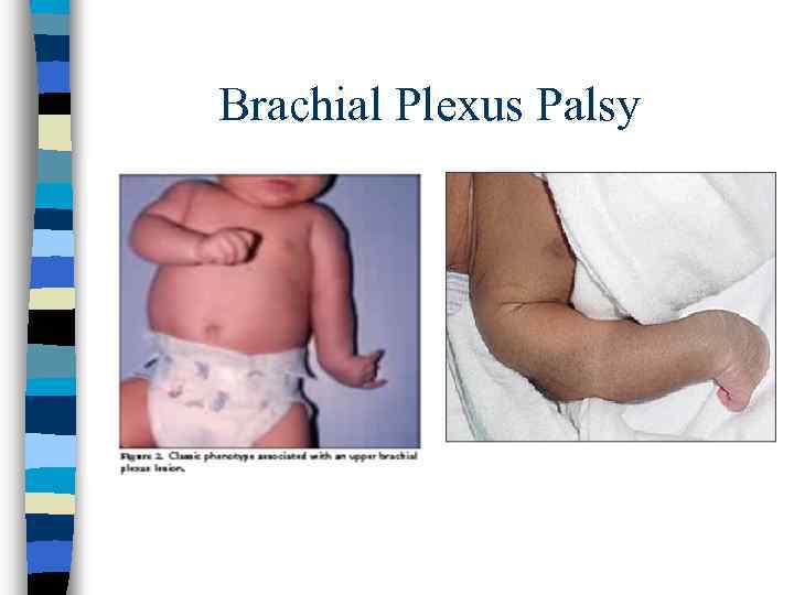 Brachial Plexus Palsy 