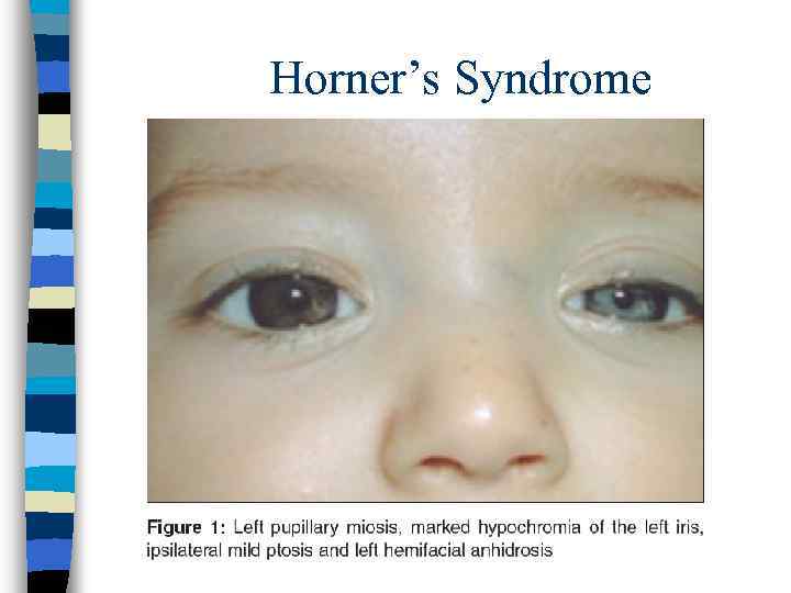  Horner’s Syndrome 