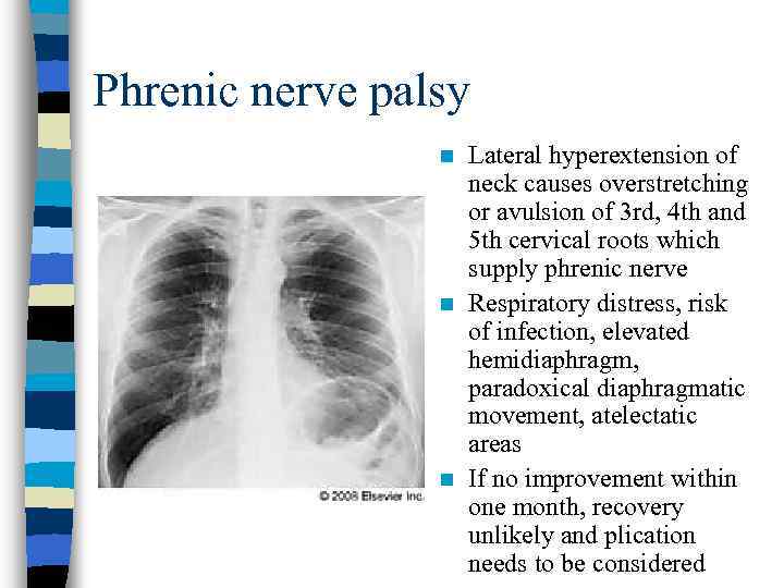 Phrenic nerve palsy Lateral hyperextension of neck causes overstretching or avulsion of 3 rd,