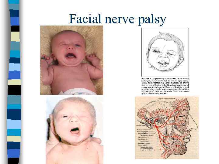 Facial nerve palsy 