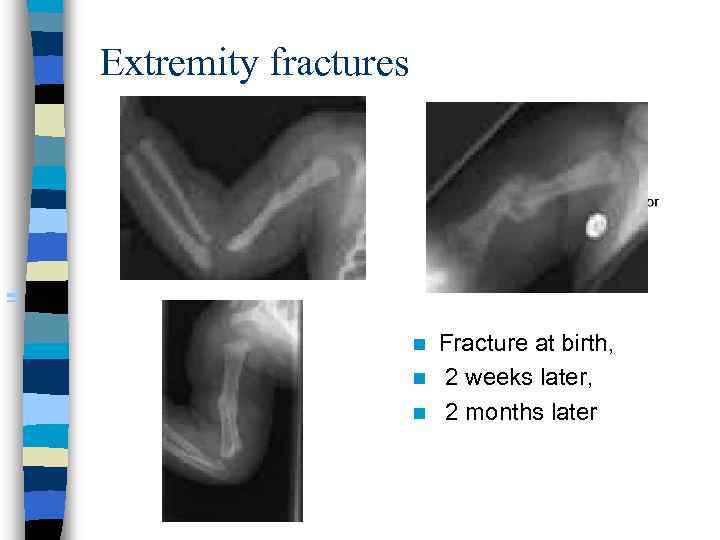 Extremity fractures Fracture at birth, n 2 weeks later, n 2 months later n