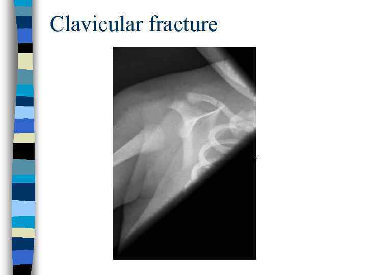 Clavicular fracture 