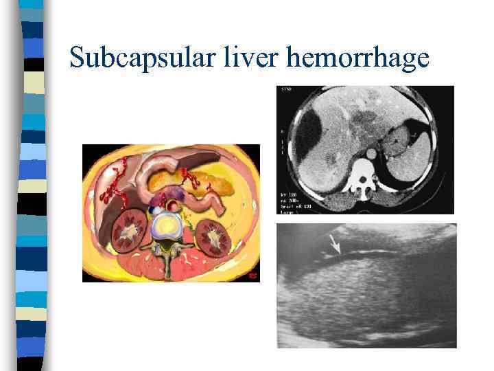 Subcapsular liver hemorrhage 