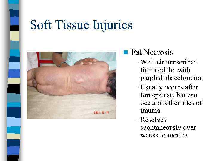 Soft Tissue Injuries n Fat Necrosis – Well-circumscribed firm nodule with purplish discoloration –