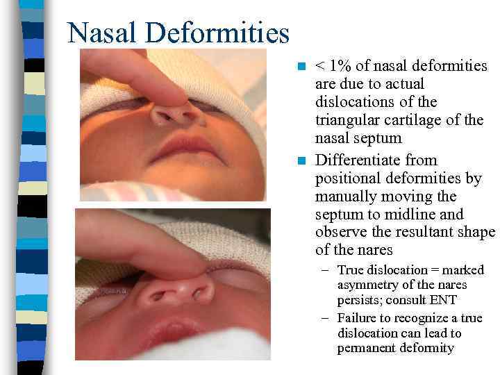 Nasal Deformities < 1% of nasal deformities are due to actual dislocations of the