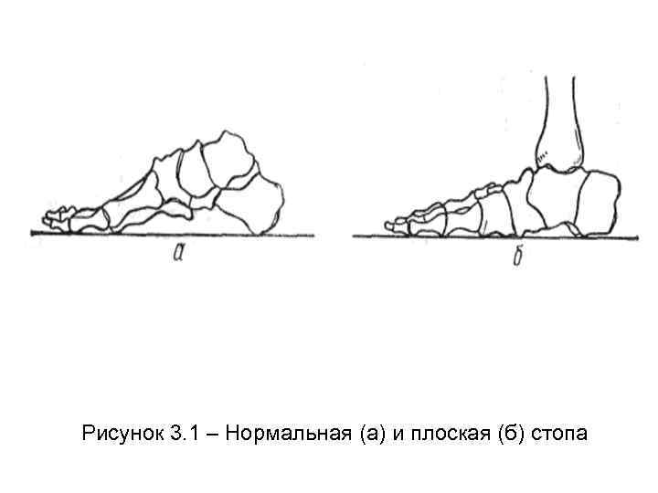 Рисунок 3. 1 – Нормальная (а) и плоская (б) стопа 