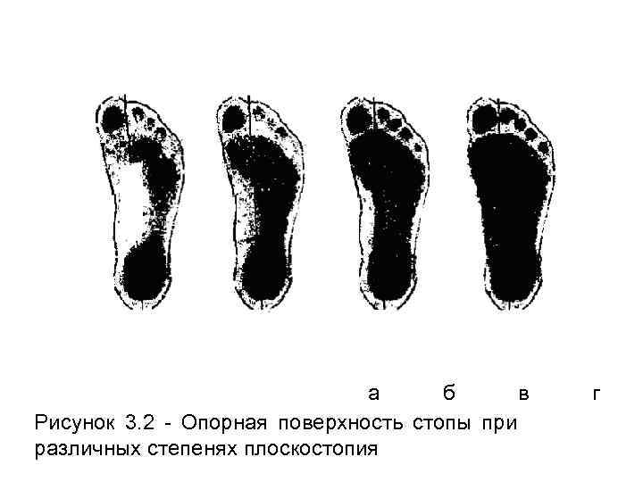 Продольное плоскостопие 2 степени