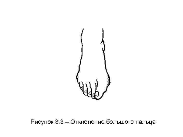 Рисунок 3. 3 – Отклонение большого пальца 
