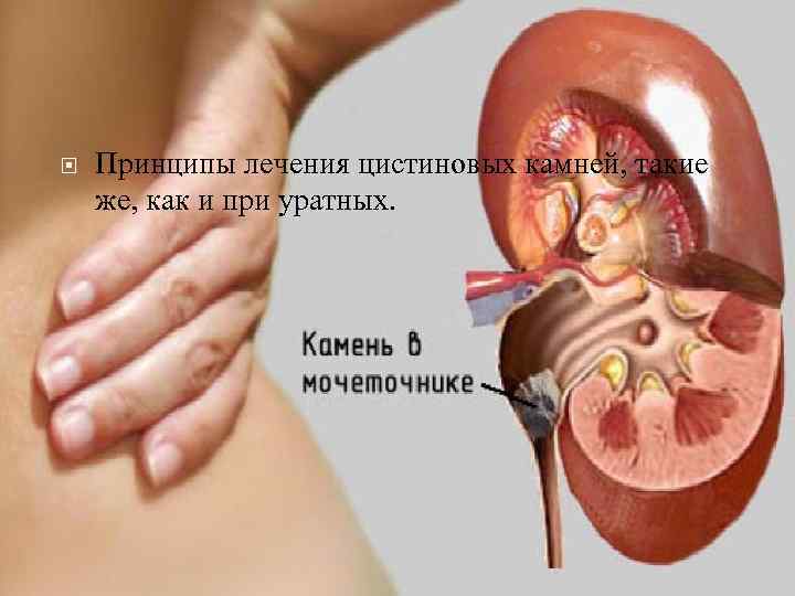  Принципы лечения цистиновых камней, такие же, как и при уратных. 