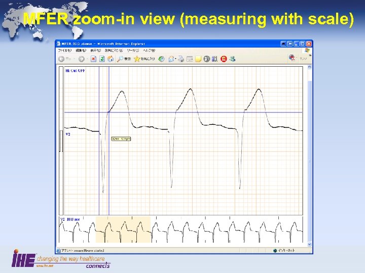 MFER zoom-in view (measuring with scale) 