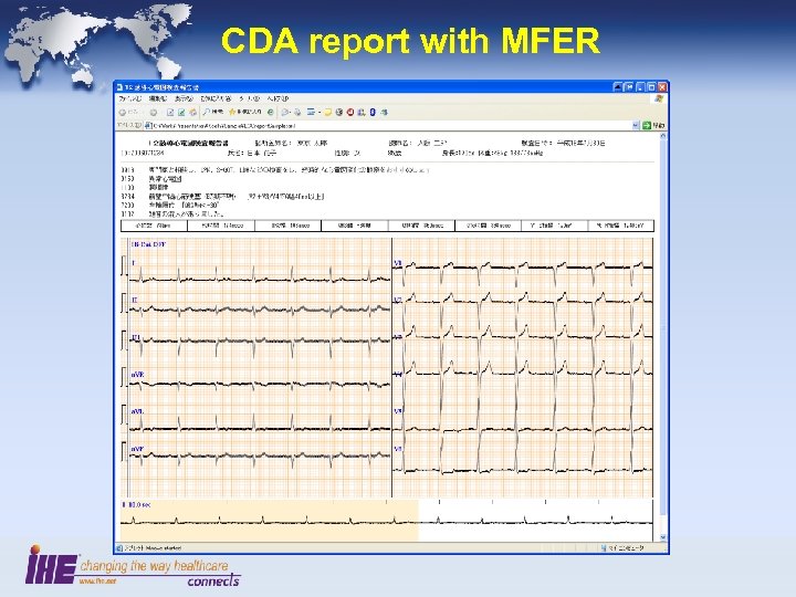 CDA report with MFER 