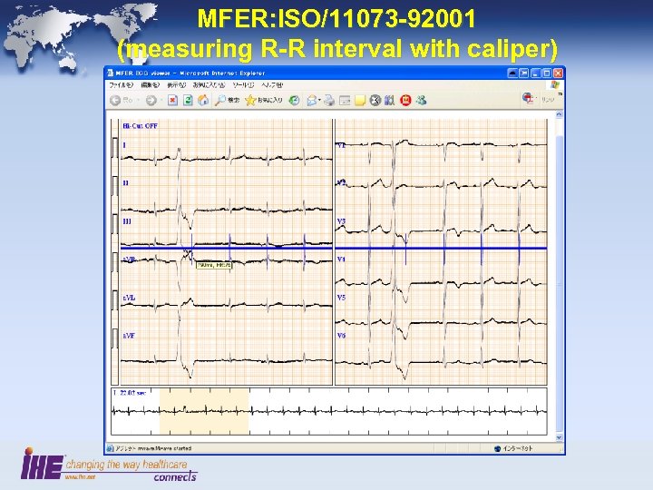 MFER: ISO/11073 -92001 (measuring R-R interval with caliper) 