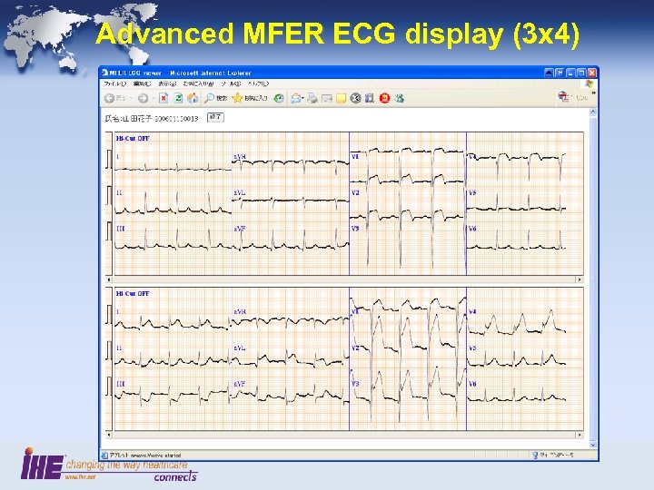 Advanced MFER ECG display (3 x 4) 