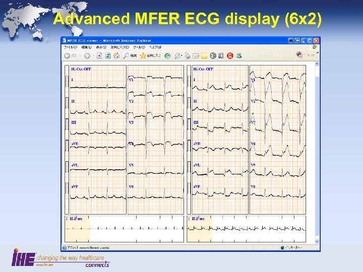 Advanced MFER ECG display (6 x 2) 