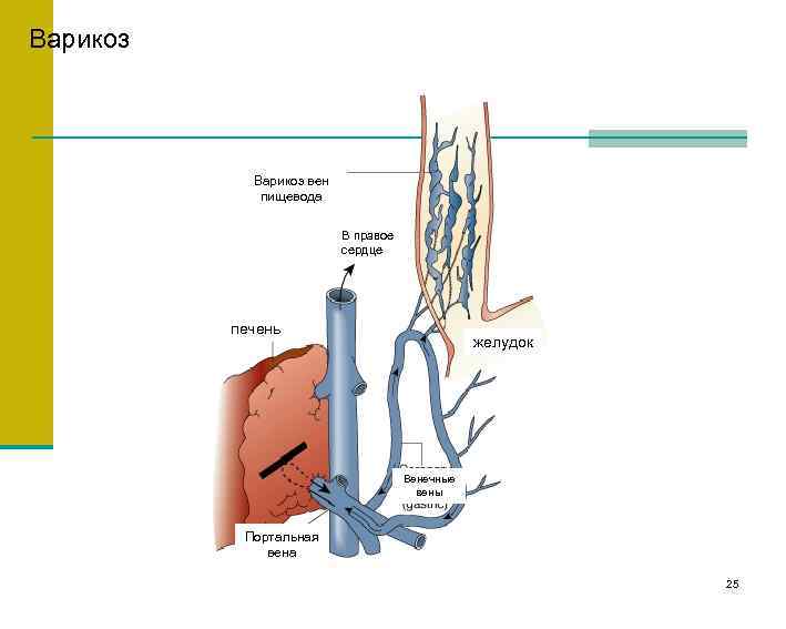 Варикоз вен пищевода В правое сердце печень желудок Венечные вены Портальная вена 25 
