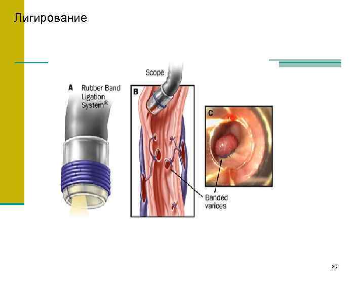 Лигирование 29 