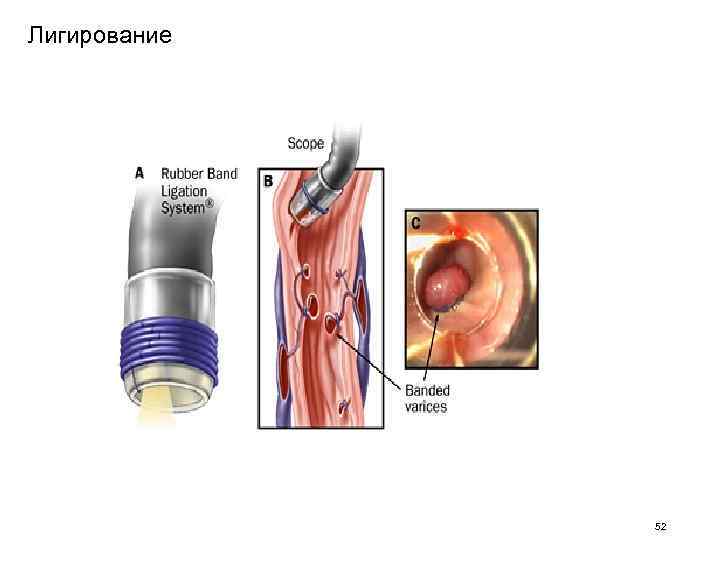 Лигирование 52 