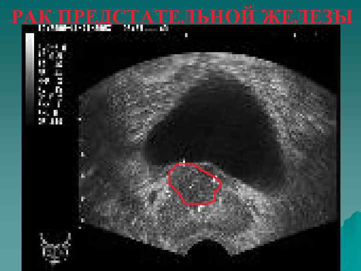 Как выглядит рак предстательной железы на узи фото