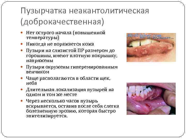 Пузырчатка неакантолитическая (доброкачественная) Нет острого начала (повышенной температуры) Никогда не поражается кожа Пузыри на