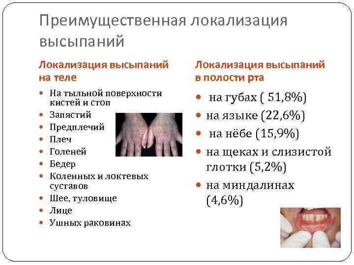 Преимущественная локализация высыпаний Локализация высыпаний на теле Локализация высыпаний в полости рта На тыльной