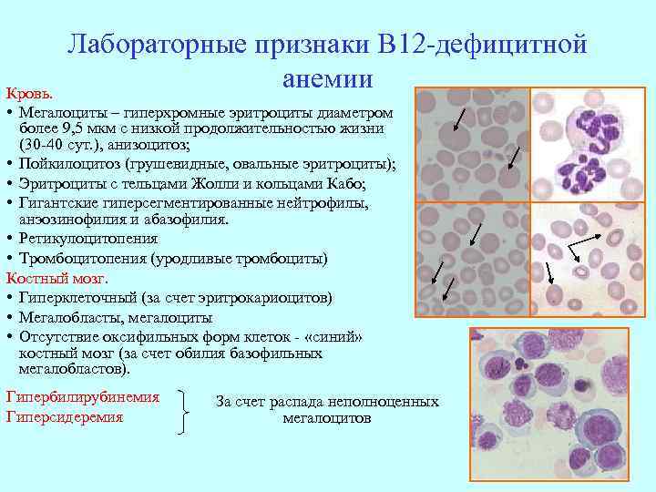 Лабораторные признаки В 12 -дефицитной анемии Кровь. • Мегалоциты – гиперхромные эритроциты диаметром более