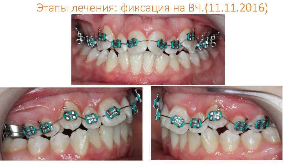 Этапы лечения: фиксация на ВЧ. (11. 2016) 