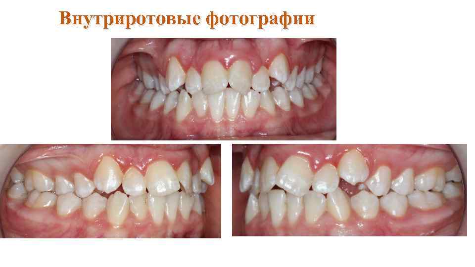 Внутриротовые фотографии 